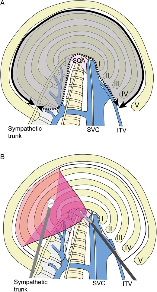 (A) Incision of parietal pleura and range of mobilization. Parietal pleura are incised with an electric cautery from the internal thoracic vein anteriorly to the sympathetic nerve trunk posteriorly (solid line). Parietal pleura are mobilized to the superior vena cava anteriorly and the vertebral body posteriorly (dotted line). Parietal pleura (dark area) are stripped. SCA: subclavian artery; SVC: superior vena cava; ITV: internal thoracic vein. (B) Mobilization of parietal pleura. The cut edge of the parietal pleura is grasped with forceps and dissected bluntly using an instrument, such as a peanut dissector.