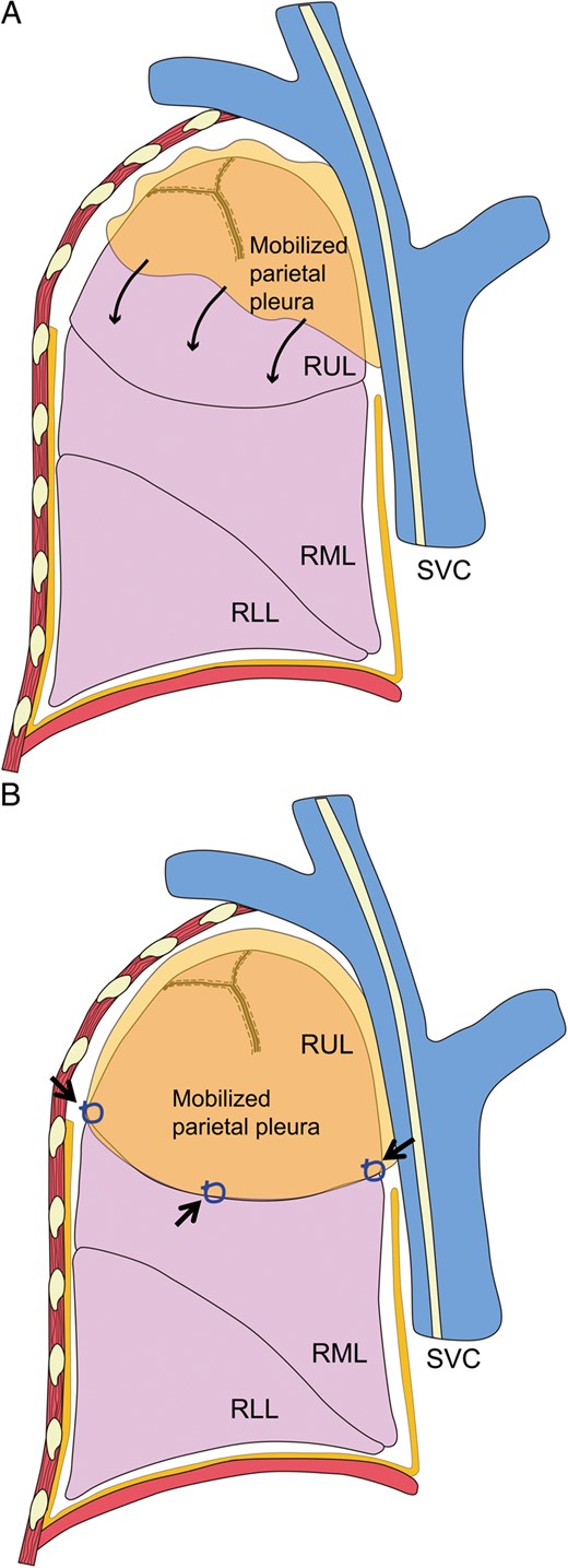 (A) Stripped pleura covering the right upper lobe or upper segment. The stripped parietal pleura stretches down to cover the upper lobe on the right side and the upper segment on the left side (thin arrows). (B) The edge of the pleura is tied to the edge of the right upper lobe at two or three sites (thick arrows). RUL: right upper lobe; RML: right middle lobe; RLL: right lower lobe; SVC: superior vena cava.