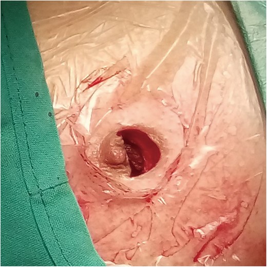 An arc incision was made along the inferior areola border in the transareolar single-port procedure Group.