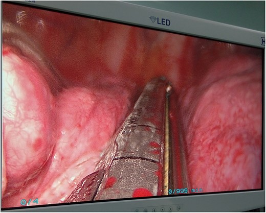 Intrathoracic view on the screen during the transareolar single-port procedure.