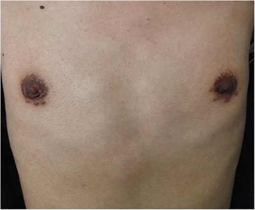 Transareolar bilateral scars were not obvious 6 months after surgery.