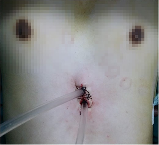 Bilateral chest drainages were performed through a subxiphoid incision.