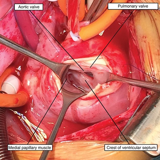Intraoperative photograph showing the defect approached through a longitudinal incision in the pulmonary trunk, with continuity between the leaflets of the aortic and pulmonary valves.