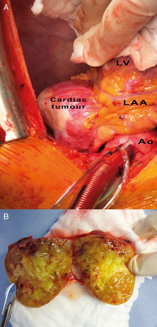 Illustration of the cardiac tumour in situ, bordering the
left atrial appendage (LAA), the left ventricle (LV) and the ascending aorta
(Ao). (A) Longitudinal section through the cardiac tumour shows
its macroscopic inner structure. The tumour is surrounded by a connective
tissue in a capsule-like fashion. The tumour parenchyma is no-dose and
inhomogeneous, with a star-shaped scar and signs of haemorrhage in the
centre (B).