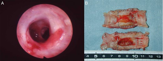 (A) By bronchoscopy, moderate stenosis was seen post implantation (month 10) at the proximal end of the prosthesis in dog 6. (B) No anastomotic dehiscence on a macroscopic post-implantation view of the prosthesis but moderate stenosis was present (arrow).