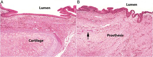 (A) Light microscopic view of normal histological structure of the host trachea near the anastomotic site, including mucosa, submucosa and cartilage. (B) Neomucosa with epithelial lining on the mesh near the anastomotic site. The surface of the prosthesis was covered with ciliated columnar epithelium. Adjacent connective tissue had invaded through the pores of the mesh with ingrowth of some vessels (arrow). (Both, haematoxylin and eosin staining; original magnification, ×40).