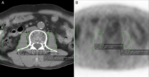Representative cases of measuring the psoas muscle area. (A) The total psoas muscle area was 15.791 cm2. (B) The mean SUV was 7.892 in the same area. SUV: standardized uptake value.
