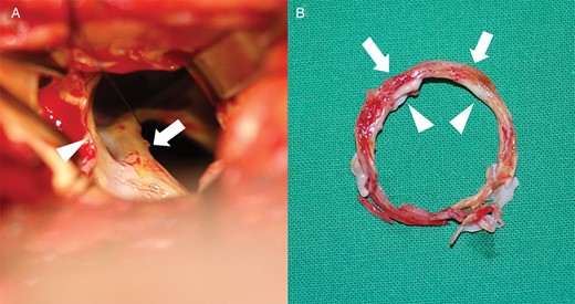 (A) Subvalvular pannus (arrow) around mechanical mitral valve, visible through the aortic valve opening (arrowhead) after aortic valve excision. (B) Subvalvular pannus ring included an inner calcified sharp ring (arrowheads) and an outer hard fibrotic ring (arrows).