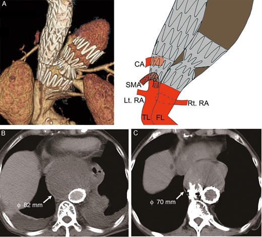 (A) Postoperative CTA demonstrated complete closure of the new entry. (B) CTA at discharge; (C) 1-year follow-up CT. CTA: computed tomography angiogram; RA: renal artery; CA: celiac artery; FL: false lumen; TL: true lumen; SMA: superior mesenteric artery.
