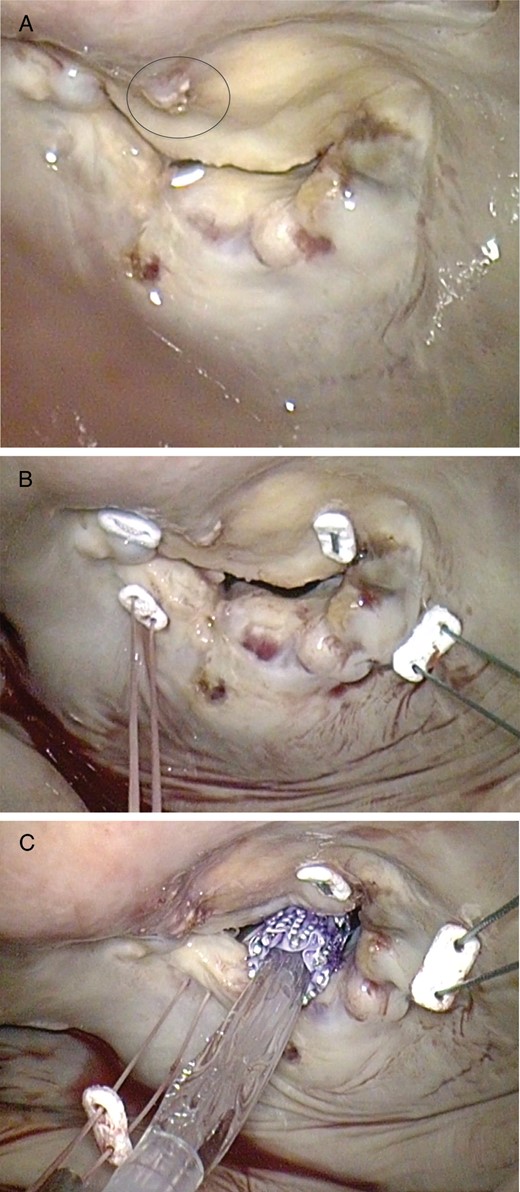 Intraoperative images taken with the endoscope. (A) View of the mitral valve. The severe calcification of the posterior annulus as well as the protruding strut of the aortic bioprosthesis (circle) can be appreciated. (B) Placement of one pledgeted polyfilament annuloplasty U-suture in each commissure. (C) Introduction and placement of the transcatheter aortic valve.