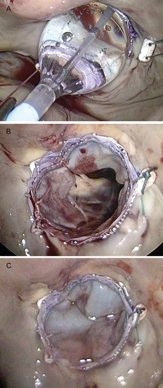 Intraoperative images taken with the endoscope. (A) Balloon inflation and deployment of the transcatheter valve. (B) Valve inspection after deployment. (C) Assessment of the result after water testing.