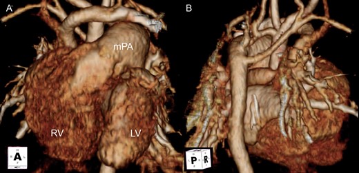 Preoperative CT. (A) Anterior view. (B) Posterior view. Five individual cervical branches arise separately. The transverse arch is severely hypoplastic. Left and aberrant right subclavian arteries arise from the descending aorta. RV: right ventricle; LV: left ventricle; mPA: main pulmonary artery.