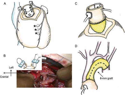 (A) After pulmonary autograft removal, the subaortic valvular muscle protrusion was resected (black arrows). Muscular ventricular septal defect (VSD) (black stars) and a perimembranous VSD (white star) are indicated. (B) The right angle clamp was inserted from muscular VSDs on right ventricule side to the perimembranous VSD through LV. The sandwich technique was applied. (C) A pulmonary autograft was implanted in the left ventricular outflow tract, and the VSD was rerouted using patch. (D) The aortic arch was bridged with an 8-mm expanded polytetrafluoroethylene graft.