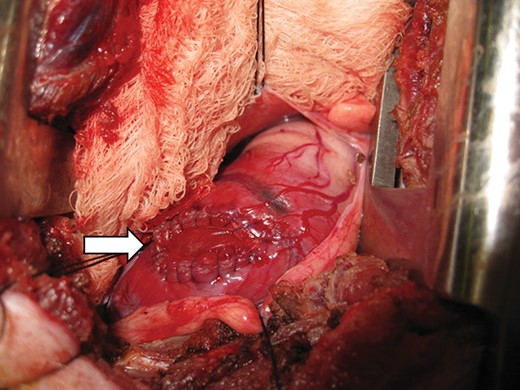 A representative intraoperative surgeon's view of implanted right ventricle patch. White arrow: patch area.