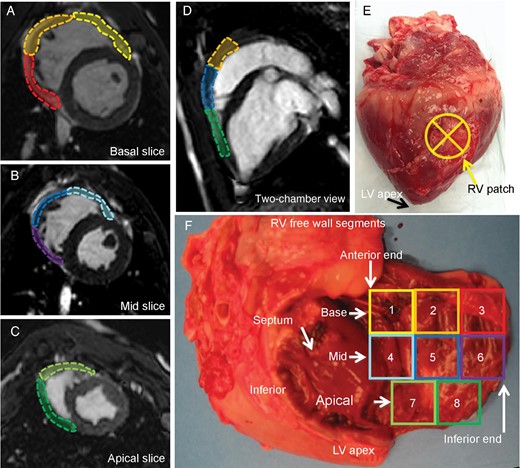 The right ventricular free wall segments. The right ventricular free wall was divided into eight sections using left ventricle segmentation as a reference: (A) The basal segment and (B) mid segment are further divided into anterior, lateral and inferior segments. (C) The apical slice is smaller compared with other two longitudinal segments and is divided into anterior and inferior segments. (E) An example of macro inspection of the right ventricle patch on the mid-lateral segment. (F) A photograph of the extracted heart with the right ventricle free wall cut at the basal-inferior-apical end and opened. The colour of the eight segments corresponds to A–D. In this specimen, the patch is located in 5, 7 and 8 (i.e. mid apical–lateral wall). Inferior: right ventricular inferior wall; LV: left ventricle; RV: right ventricle; septum: interventricular septum.
