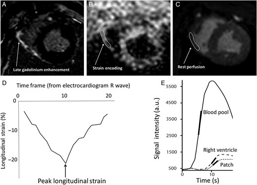 Scheme of analysis for strain encoding and rest perfusion. (A) The 2D-late gadolinium enhancement image is used to detect the target lesion along with the macro inspection. Corresponding image slice is selected for (B) strain encoding and (C) rest perfusion. The region of interest is manually picked which will generate (D) longitudinal strain curve and (E) signal intensity curve. The arrow and encircled area indicate the location of implanted patch. The peak strain is the value obtained at end-systole (2D). The relative maximum upslope is obtained from the ratio of maximum upslope of the target lesion to the maximum upslope of the blood pool (left ventricular cavity).