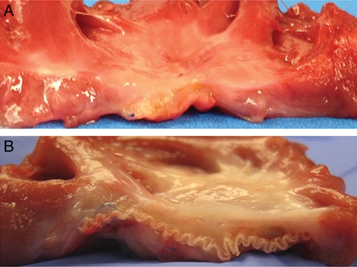Macro inspection. Cross-section (endocardial surface facing up) of the extracted patch and surrounding at 60 days after implantation. (A) Extracellular matrix patch derived from small intestine submucosa; (B) Dacron patch.