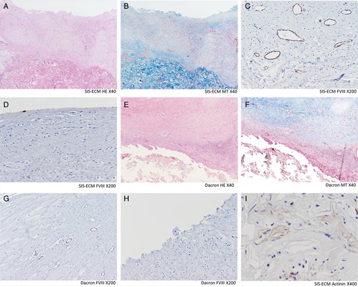 Histology and immunohistochemistry. SIS-ECM (A–D and I): Well-organized cells (shown in A and B) including monolayer of endothelial cells on the endocardial surface (shown in D) and layers of scattered α-sarcomeric actinin-positive cells (shown in I), were observed. The repopulated cells were predominantly observed on the SIS-ECM and extended towards the endocardial surface. Dacron (E–H): Significant infiltration of lymphoid cells and fibrosis is observed (shown in E and F). No endothelial cells were observed in the endocardial surface (shown in G). Capillary density (C and G): The factor-VIII-related antigen-positive capillaries were counted under the ×200 microscopy for capillary density analysis. Vasculogenesis/angiogenesis was significantly more prevalent in SIS-ECM patch. Dacron: Dacron patch; FVIII: immunohistochemistry staining for factor-VIII-related antigen; HE: haematoxylin–eosin staining; MT: Masson trichrome staining; SIS-ECM: extracellular matrix patch derived from small intestine submucosa.