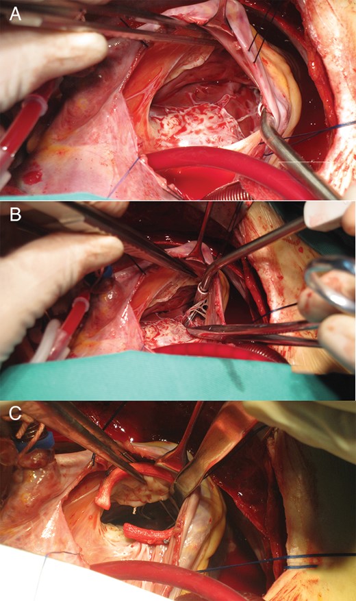 Abnormality of the tricuspid valve papillary muscle and surgical correction. (A) Absence of the anterior papillary muscle. (B) Presence of the septal papillary muscle and the posterior papillary muscle. (C) Placement of a Gore-Tex® suture on the rough edge of the anterior leaflet.