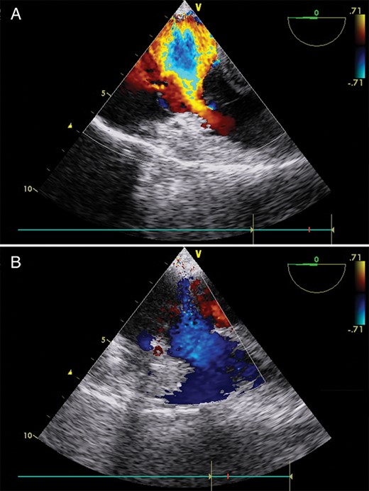 Changes of regurgitation of the tricuspid valve (TEE). (A) Preoperative TEE image confirming severe tricuspid valve regurgitation. (B) Postoperative TEE image showing satisfactory tricuspid valve competence.