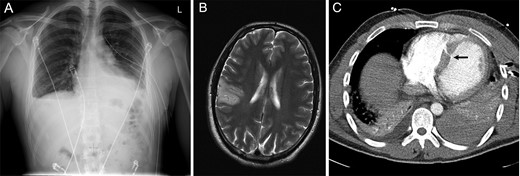 Radiological Imaging. (A) Chest X-ray showing a large left-sided pleural effusion. (B) MRI of the brain demonstrated a large parietal watershed area infarct. (C) CT Thorax demonstrating a moderate left-sided pleural effusion/haemothorax and a VSD (arrow).