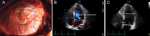 Echocardiograms and intraoperative images. (A) Intraoperative image demonstrating the knife entry point in the free wall of the right ventricle; (B) Transthoracic echocardiogram demonstrating a VSD in the middle portion of the muscular part of the septum (demonstrated by the blue jet). (C) Transthoracic echocardiogram after VSD occlusion.