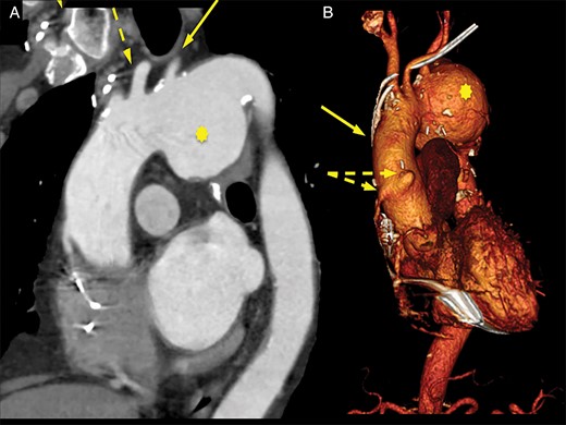 (A) Oblique sagittal reconstruction shows the pseudoaneurysm (asterisk), LSA (solid arrow) and LCCA (dashed arrow). (B) Three-dimensional reconstruction shows the relationship between the aortocoronary grafts (dashed arrows) and the BCT (solid arrow).