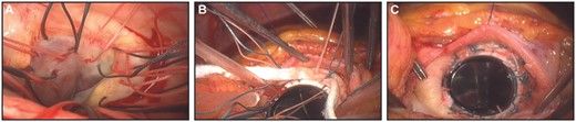 Aortic valve replacement by SEIV. (A) Subannular multiple interrupted sutures were in place. (B and C) After the Teflon felt strip was interposed between the sewing ring and the endomyocardium, suture threads were tied.