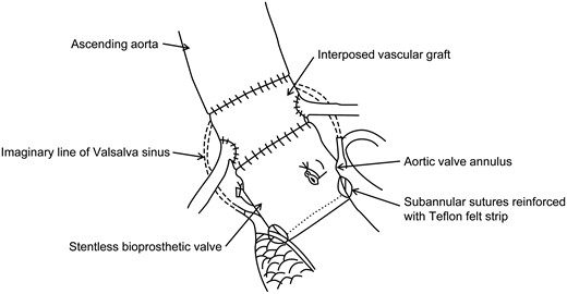 Schematic drawing of aortic root replacement with stentless bioprothetic valve by SEIV.