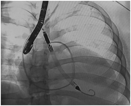 Insertion of Impella LVAD under fluoroscopy and echocardiography guidance