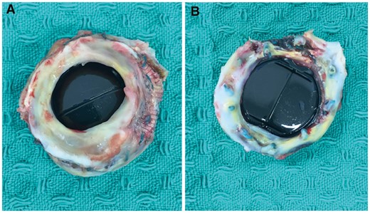 The 23-mm Duromedic mechanical valve with a subvalvular pannus that was removed from the patient.