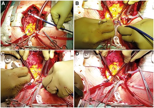 (A) The Sapien 3 valve (Edwards Lifesciences, Irvine, CA) is prepared and crimped in a transaortic-transcatheter orientation with the inflow close to the tip of the balloon catheter. (B) After the previously implanted valve is removed, the Sapien 3 is positioned in the aortic annulus such that the commissure corresponds with the anatomy of the native valve. (C) The balloon is slowly inflated to maintain the position. (D) The final result with the Sapien 3 valve in place.