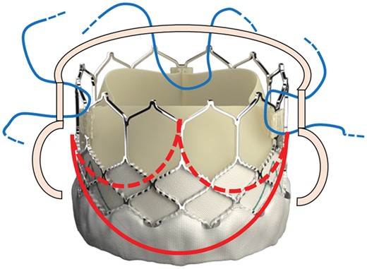 The Sapien 3 valve with the schematic view of the aortic valve annulus (red lines) and the location of the three 4-0 polypropylene U-shaped stitches (blue lines) placed across the metal frame at the top of the three valve commissures to fix the valve to the aortic wall.