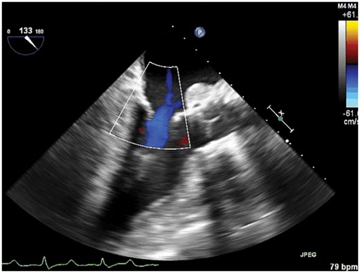 Postoperative echocardiogram showing the Sapien 3.