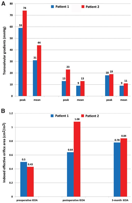 (A) Aortic transvalvular mean and peak gradients before and after the procedure. (B) iEOA before and after the procedure.