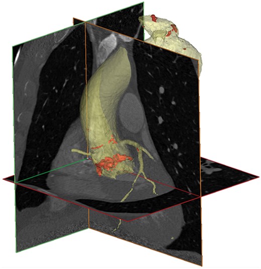 Virtual 3D reconstruction of the thoracic aorta including the aortic root based on DSCT using Mimics™. The aorta (yellow) and aortic valve calcium (red) were isolated in a semi-automated fashion.