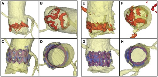 Aortic annuli of 2 patients with different amounts of calcification (left: Patient 1 with moderate calcification, right: Patient 2 with heavy calcification) before (top row) and after TAVI (bottom row). A, C, E, G: side view B, D, F, H: view from top. Pre-procedural calcium is dyed red, post-procedural blue. The THV stent is visualized in purple.