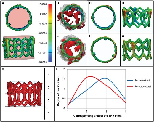 The degree of stent expansion was assessed with regards to the aortic valvular calcification. The isolated reconstruction of the stent was placed within a cylinder resembling the specific dimensions of a fully deployed stent (A, rose coloured). Stent frame segments exceeding the cylinder (over-expanded segments) are coloured yellow and red whereas segments lying inside the cylinder (under-expanded segments) are filled blue. Normally expanded areas are coloured green (B–G). Pre- and post-procedural reconstructions are overlaid onto each other, similar to Fig. 3 (B and E). B–D: Patient 1, E–G: Patient 2. H: To analyse the vertical movement of calcific deposits, the device landing zone was divided into four segments relative to the stent frame. The degree of calcification was quantified manually on a three-point scale from 0 (= no calcium) to 2 (= large amounts of calcium). I: Graphical depiction of the calcium distribution before and after TAVI.