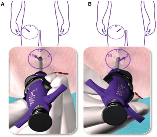 ‘Pre-closure’ technique. (A) Device is rotated approximately 30° towards the patient’s right side (approximately 10 o’clock). Device is positioned at 45° angle. Procedure is repeated at 2 o’clock (B). See (http://www.abbottvascular.com/docs/ifu/vessel_closure/eIFU_Perclose_ProGlide.pdf. (reproduced with permission).