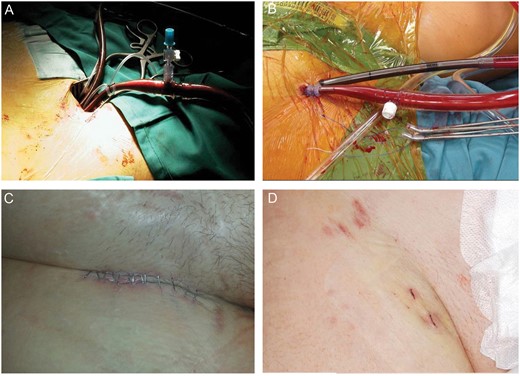 Pictures of the surgical setting after surgical access to the groin vessels (A) and transcutaneous placement of the cannulas and the use of ACDs (B) as well as their respective aesthetic result (C, D respectively). Note that in Panel D the 2 mini-cuts in the lower half of the picture compared with the percutaneous cannulation. In the upper half is the site of puncture for diagnostic cardiac catheterization.