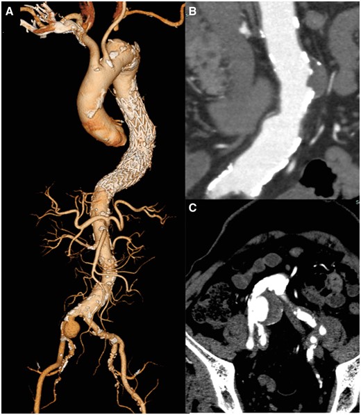 (A) 3D computed tomography reconstruction before endovascular aneurysm repair. (B) Small saccular protrusion of the abdominal aorta. (C) Right common iliac artery aneurysm.