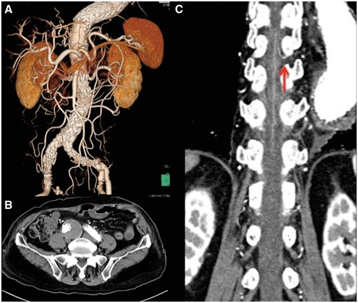 (A) 3D computed tomography reconstruction after endovascular aneurysm repair. (B) The right common iliac aneurysm after endovascular aneurysm repair. There is no endoleak. (C) The great radicular artery arising from Th9 intercostal artery (red arrow).