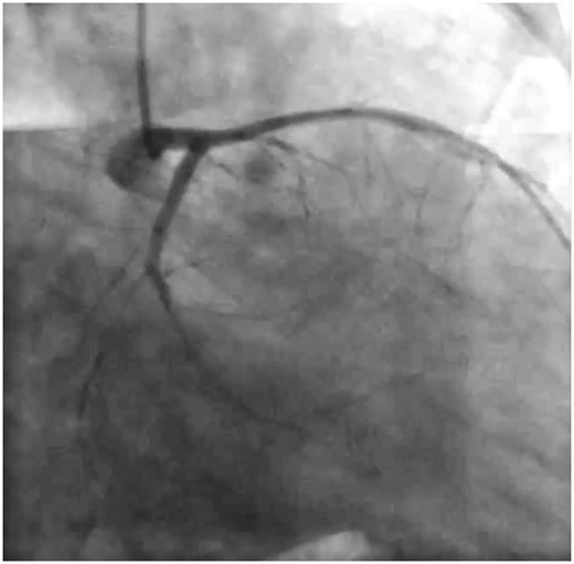 Left coronary angiogram.