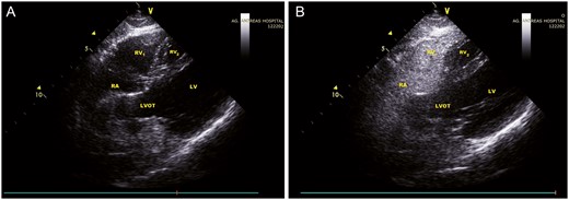 Double-chambered right ventricle. (A and B) Subcostal views showing an ‘aberrant’ cavity located between the right ventricle and the left ventricle. Following bubble injection via a left antecubital vein, this cavity (RV2) did not communicate with the main RV (RV1). LV: left ventricle; RV: right ventricle; RA: right atrium; LVOT: left ventricular outflow tract.