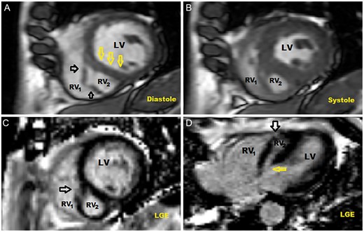 Double-chambered right ventricle. (A and B) Short-axis views showing the main LV, with its normal interventricular septum [interventricular septum (IVS), yellow arrows] and a much smaller cavity (RV2), which is separated from the main RV (RV1) by a relatively thin myocardial wall [(4, 5 mm in thickness) (black arrows)] and becomes more apparent at the medial and apical parts of the heart. The smaller cavity (RV2) has an end-diastolic volume of 15 ml and an end-systolic volume of 9 ml [ejection fraction (EF) = 38%], whereas the LV has an end-diastolic volume of 103 ml and an end-systolic volume of 35 ml (EF = 65%). (C and D) Late gadolinium enhancement imaging showing that there is no evidence of scar or fibrosis, even in the thinner parts of the RV2 ‘free wall’ (black arrows on C and D). The RV2 communicates with the LV through a non-restrictive defect in the basal membranous part (yellow arrow on D) of the IVS. LV: left ventricle; RV: right ventricle; LGE: late gadolinium enhancement.