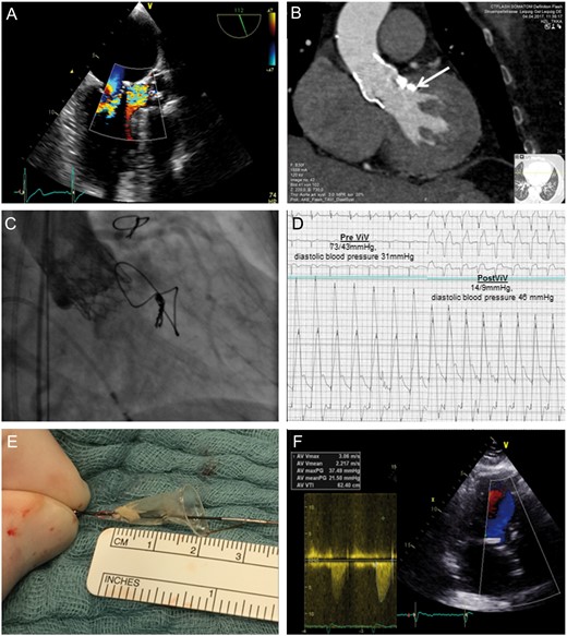 Diagnostic findings prior to valve-in-valve procedure (A and B), implantation of the SAPIEN 3 into the Sorin Perceval leading to improvement of aortic regurgitation and stenosis (C and D), embolized material caught by the cerebral protection device (E) and postoperative findings (F).