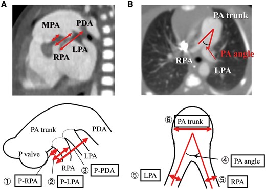 Preoperative geometric data for the hypoplastic left heart syndrome-specific anatomical malformations. We measured the following: (1) P-RPA, (2) P-LPA and (3) P-PDA. Data were adjusted for patient body weight and evaluated as an index. (4) The angle between the RPA and LPA branches was expressed as the ‘PA angle’. (5) The diameter of the RPA and LPA branches. (6) PA trunk. LPA: left pulmonary arterial; MPA: main pulmonary artery; PDA: patent ductus arteriosus; RPA: right pulmonary arterial; P-LPA: the distance between the pulmonary valve and the right pulmonary arterial branch and the base of the left pulmonary arterial branch; P-PDA: the distance between the pulmonary valve and the base of the PDA; P-RPA: the distance between the pulmonary valve and the base of the right pulmonary arterial branch; PA trunk: the diameter of the pulmonary arterial trunk.