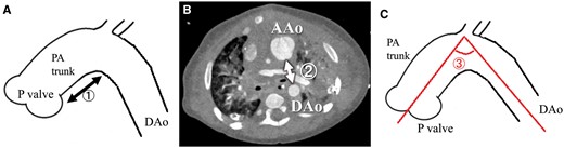Postoperative geometric data for the aortopulmonary space: (1) ‘arch height’, the distance between the inferior margin of the aortic arch and the pulmonary valve; (2) ‘arch width’, the distance between the posterior margin of the pulmonary trunk and the anterior margin of the DAo at the level of the left main bronchus and (3) ‘arch angle’, the angle between the 2 centre line of AAo and DAo, on sagittal oblique multiplanar reconstruction images. AAo: ascending aorta; DAo: descending aorta; PA trunk: the diameter of the pulmonary arterial trunk.