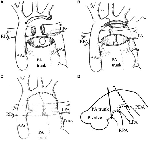 The modified Norwood procedure (pulmonary artery trunk-saving method): (A) The patent ductus arteriosus was divided, all ductal tissues were resected and the right and left pulmonary branches were divided at the base of the pulmonary trunk. (B) Defects in the pulmonary trunk were closed directly to reduce the diameter of the pulmonary trunk, and pulmonary branches were anastomosed end-to-end. (C) The arch was reconstructed by anastomosing the DAo to the aortic isthmus and distal arch. The preserved pulmonary trunk without patching was sutured to a combination of the ascending aorta. (D) Schema showing the point of pulmonary trunk dissection. Solid line indicates the point during the conventional Norwood procedure; the broken line is the point during pulmonary artery trunk-saving method. AAo: ascending aorta; DAo: descending aorta; LPA: left pulmonary arterial; P: pulmonary; RPA: right pulmonary arterial; PA trunk: the diameter of the pulmonary arterial trunk.