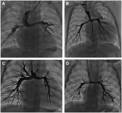Angiogram of the pulmonary artery after the pulmonary artery trunk-saving procedure and Glenn operation. A, B, C and D are the angiogram of 4 patients who underwent the pre-Fontan catheter study and showed no stenosis of central anastomosed site.